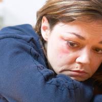 Woman with black eye rests her chin on her arms on a table